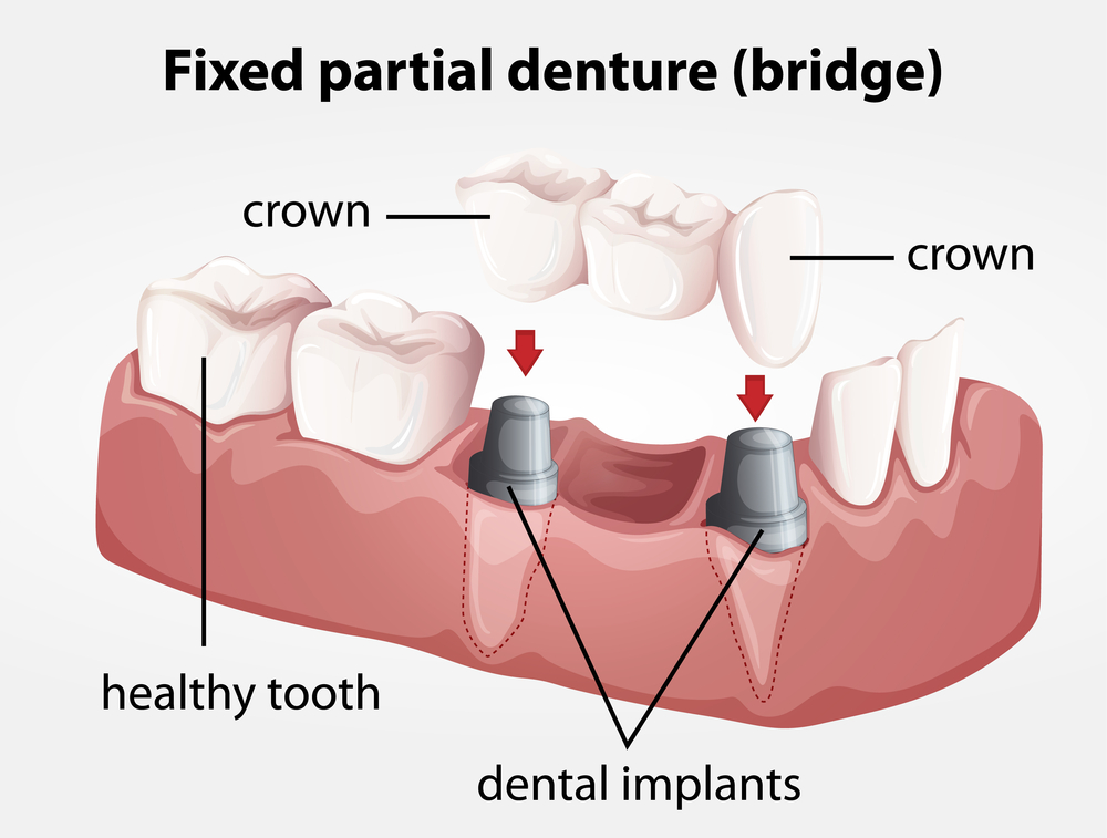 The different types of dental bridges – find the right one for you