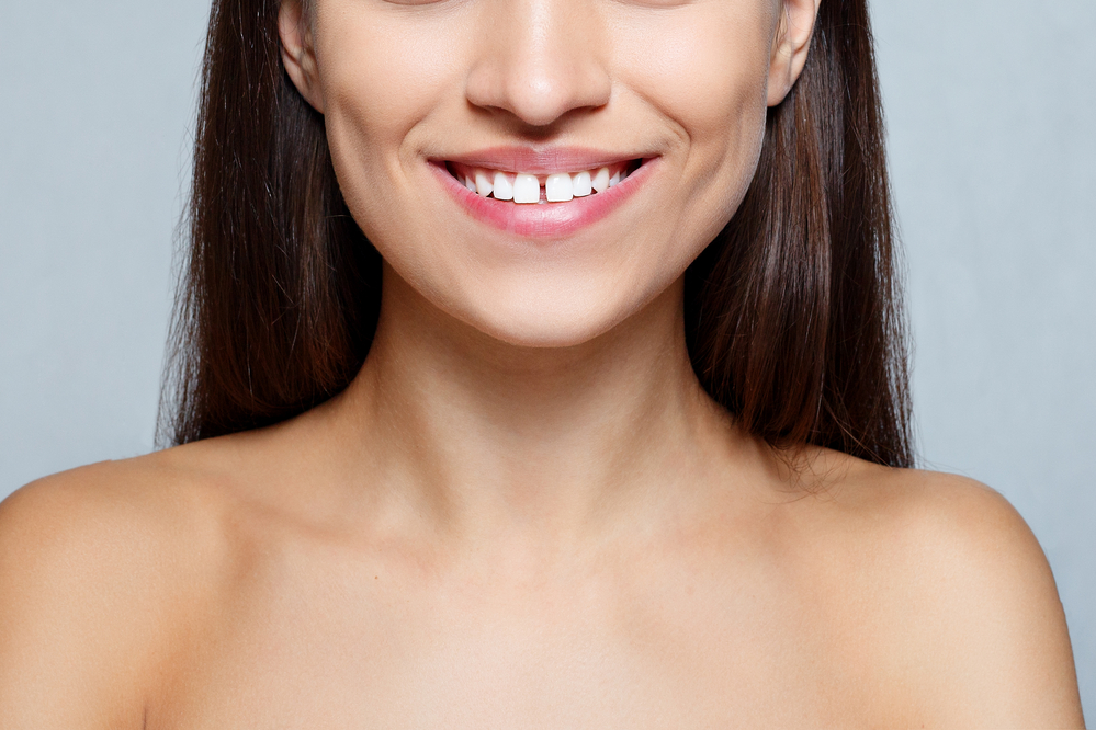 Diastema: What it is and how you can fix it