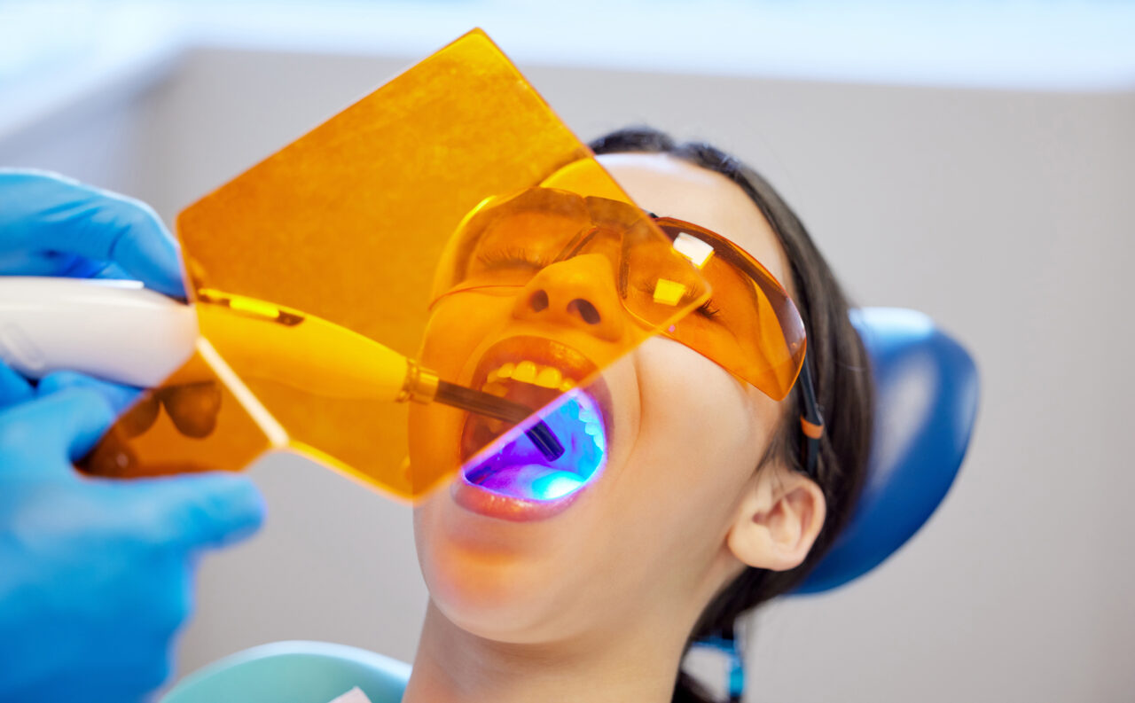 Dental bonding Everything you need to know Annex Dentistry