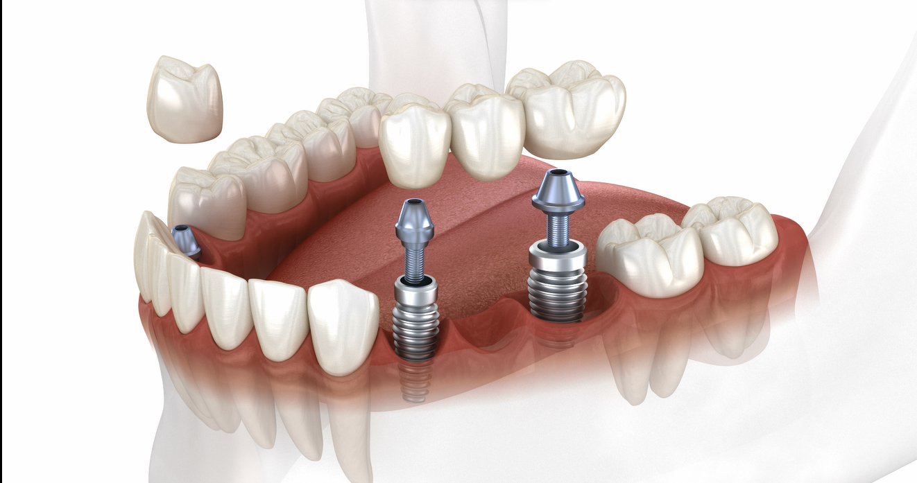 Bridge vs implants: which one is right for you?