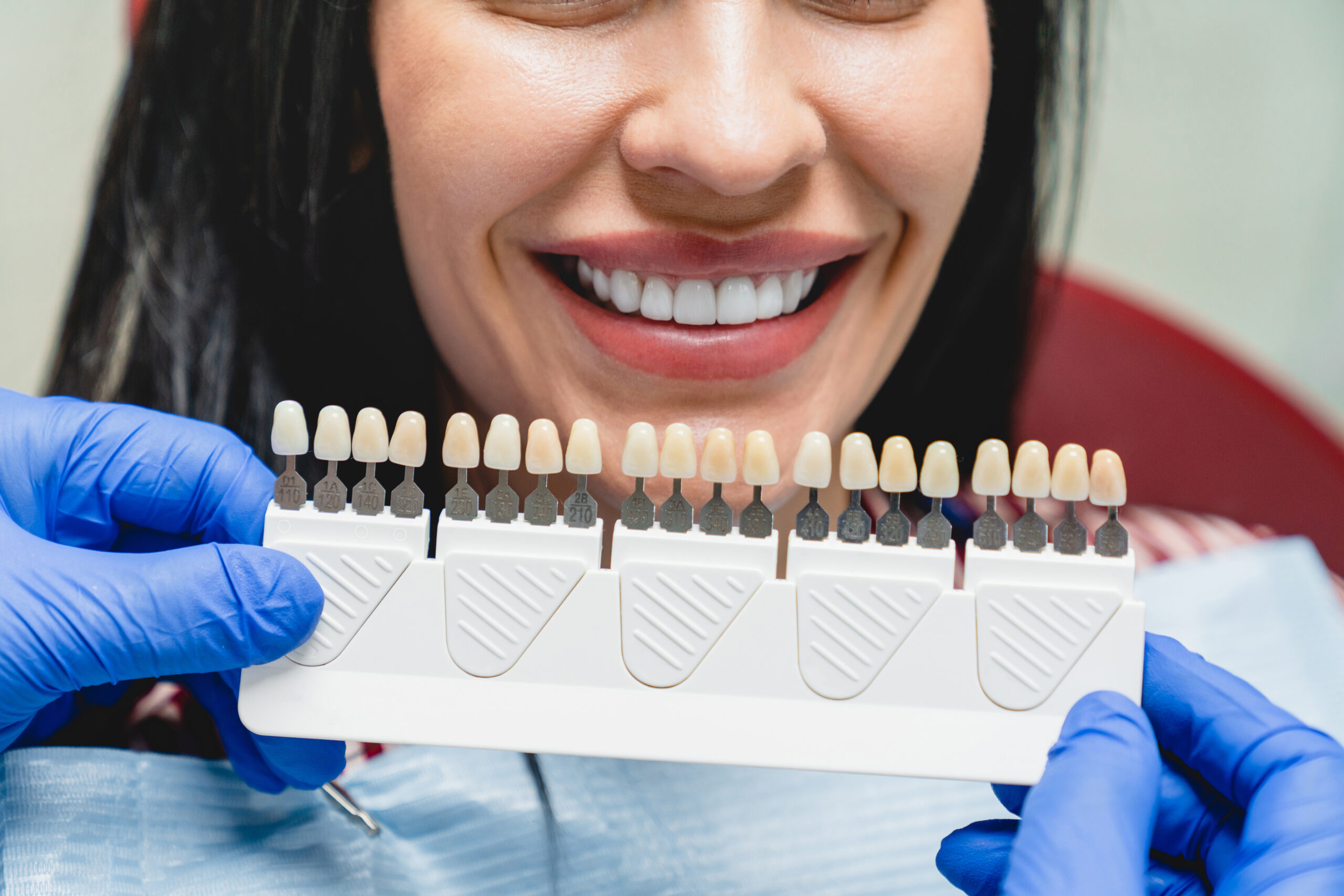 A Quick Guide to Porcelain Veneers