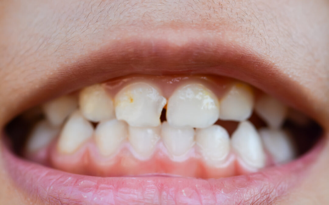 Chipped Tooth Repair: What to Do If You Have a Chipped Tooth