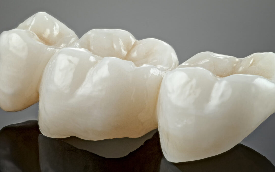 How Long Do Dental Crowns Last?